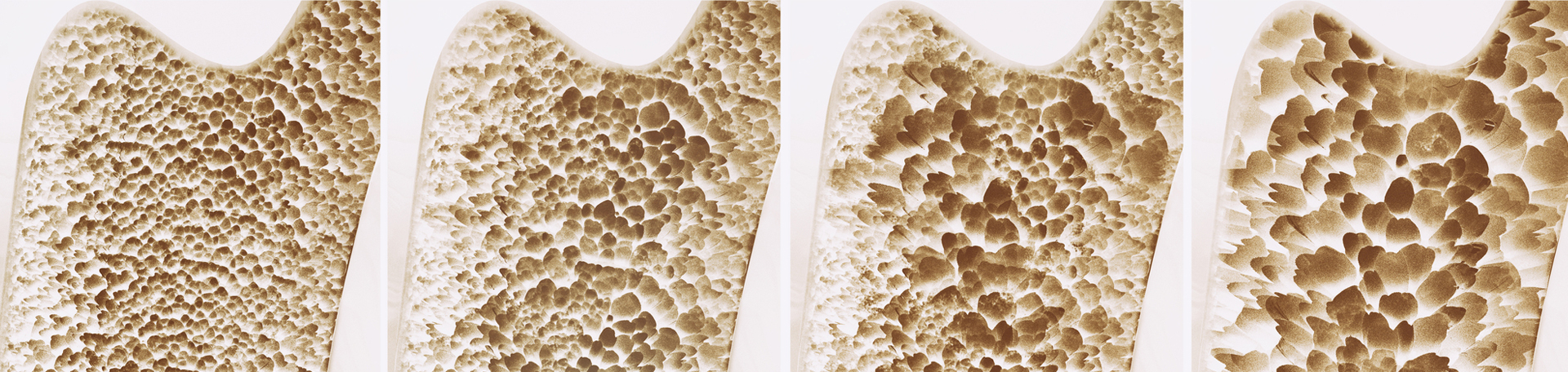 Juneau osteoporosis nutrition supported by chondroitin sulfate